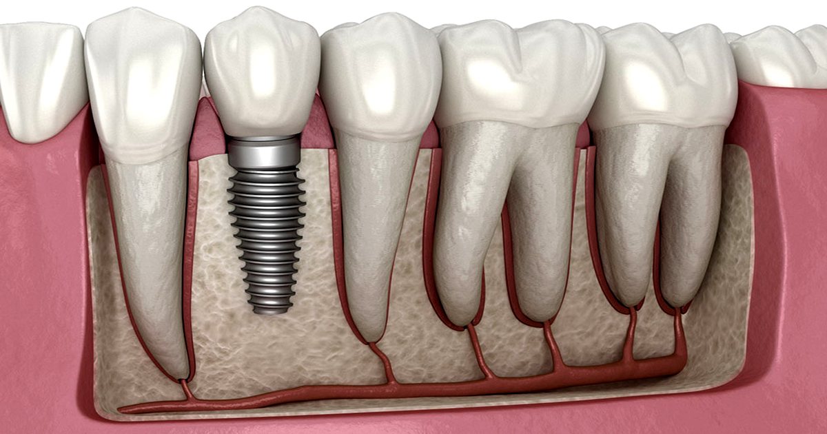 Implantes Dentários